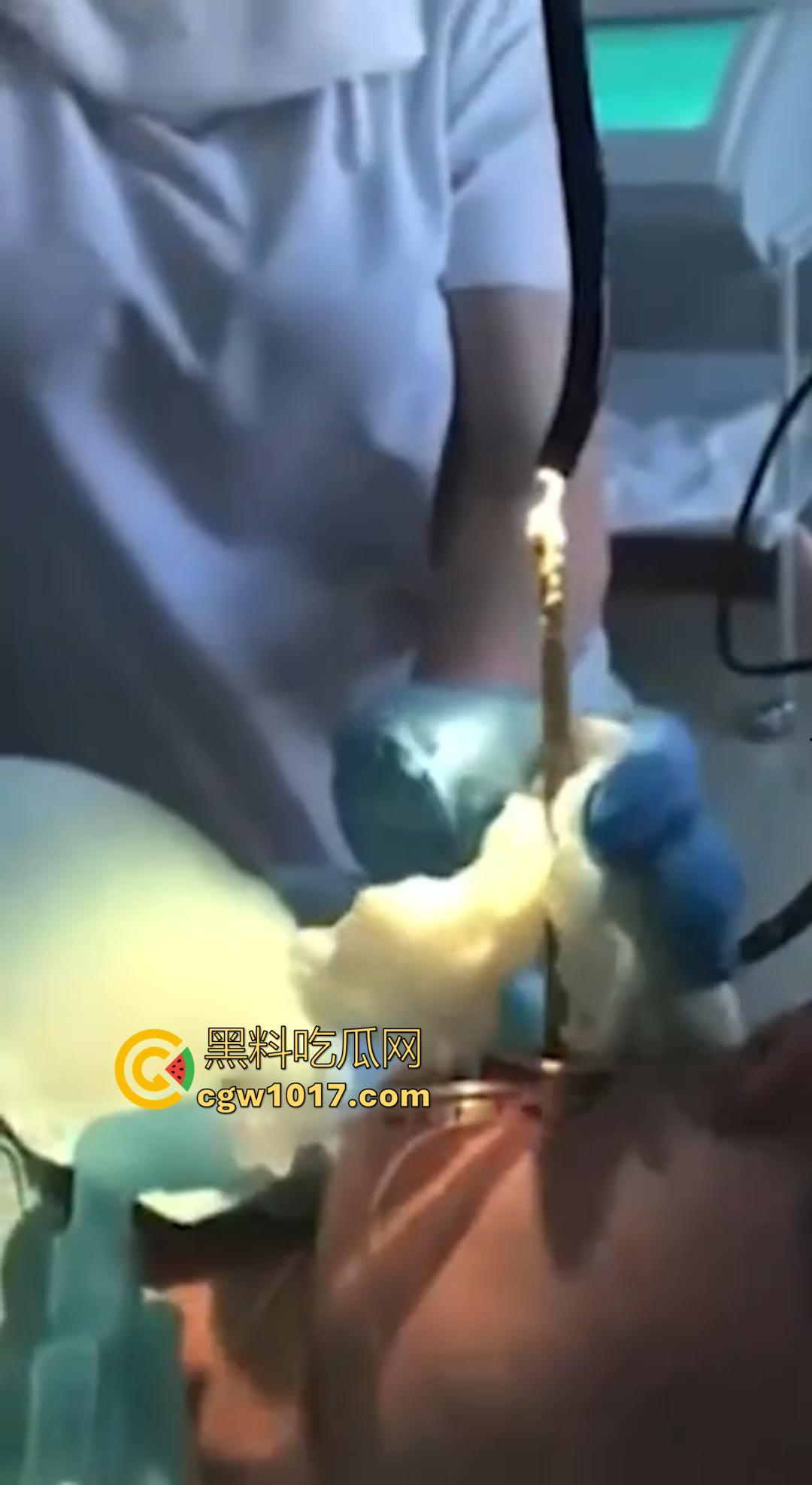 俄罗斯医院活拽1米毒蛇!女患者吞蛇卵孵化钻喉,医生手抖拽出瞬间到处乱窜!