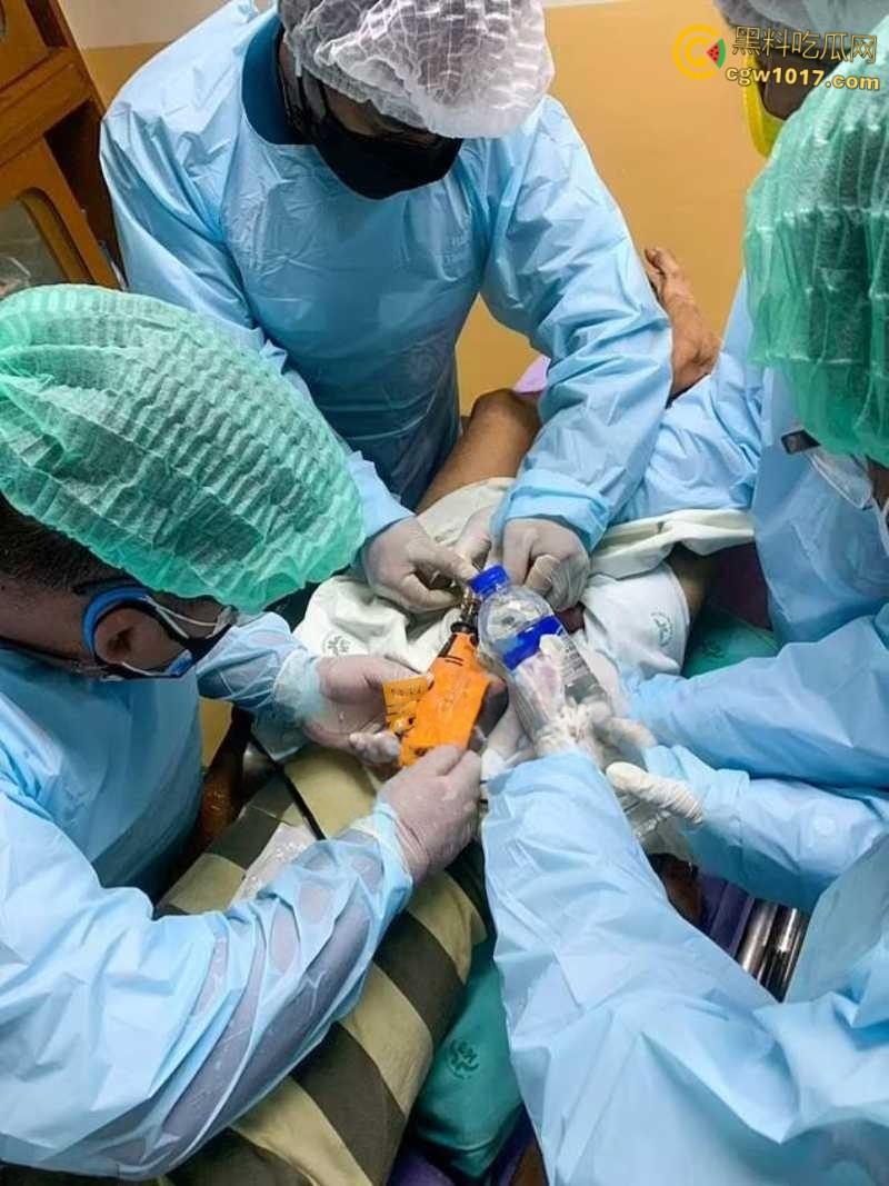 小说照进现实,男子追求刺激螺母自慰,勃起后被螺母卡住,消防人员和医生同时出动,解救被困阴茎 !