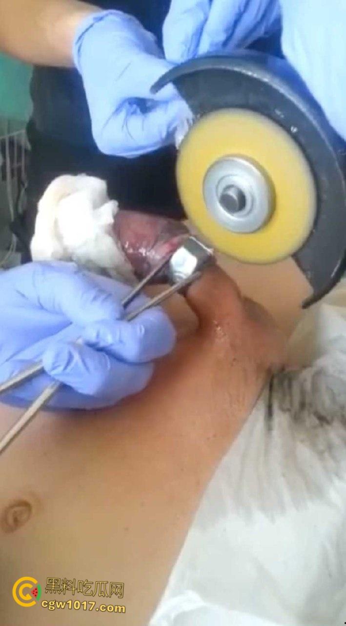 小说照进现实,男子追求刺激螺母自慰,勃起后被螺母卡住,消防人员和医生同时出动,解救被困阴茎 !