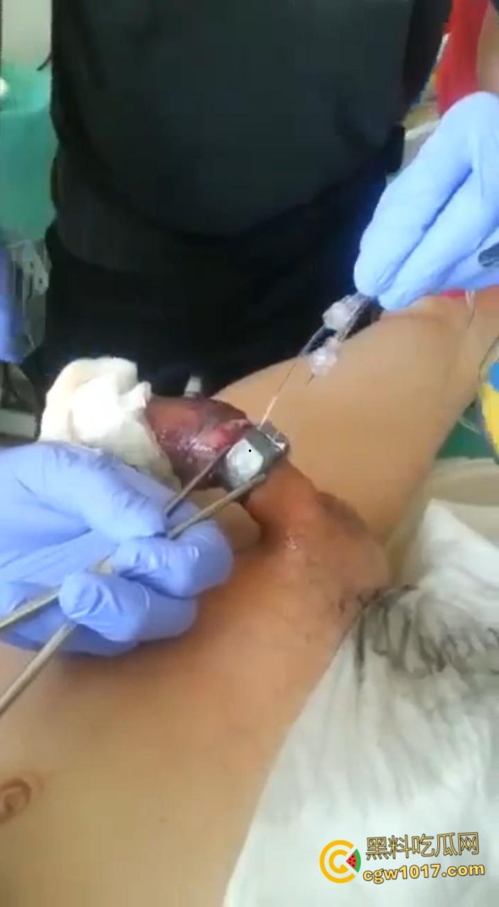 小说照进现实,男子追求刺激螺母自慰,勃起后被螺母卡住,消防人员和医生同时出动,解救被困阴茎 !