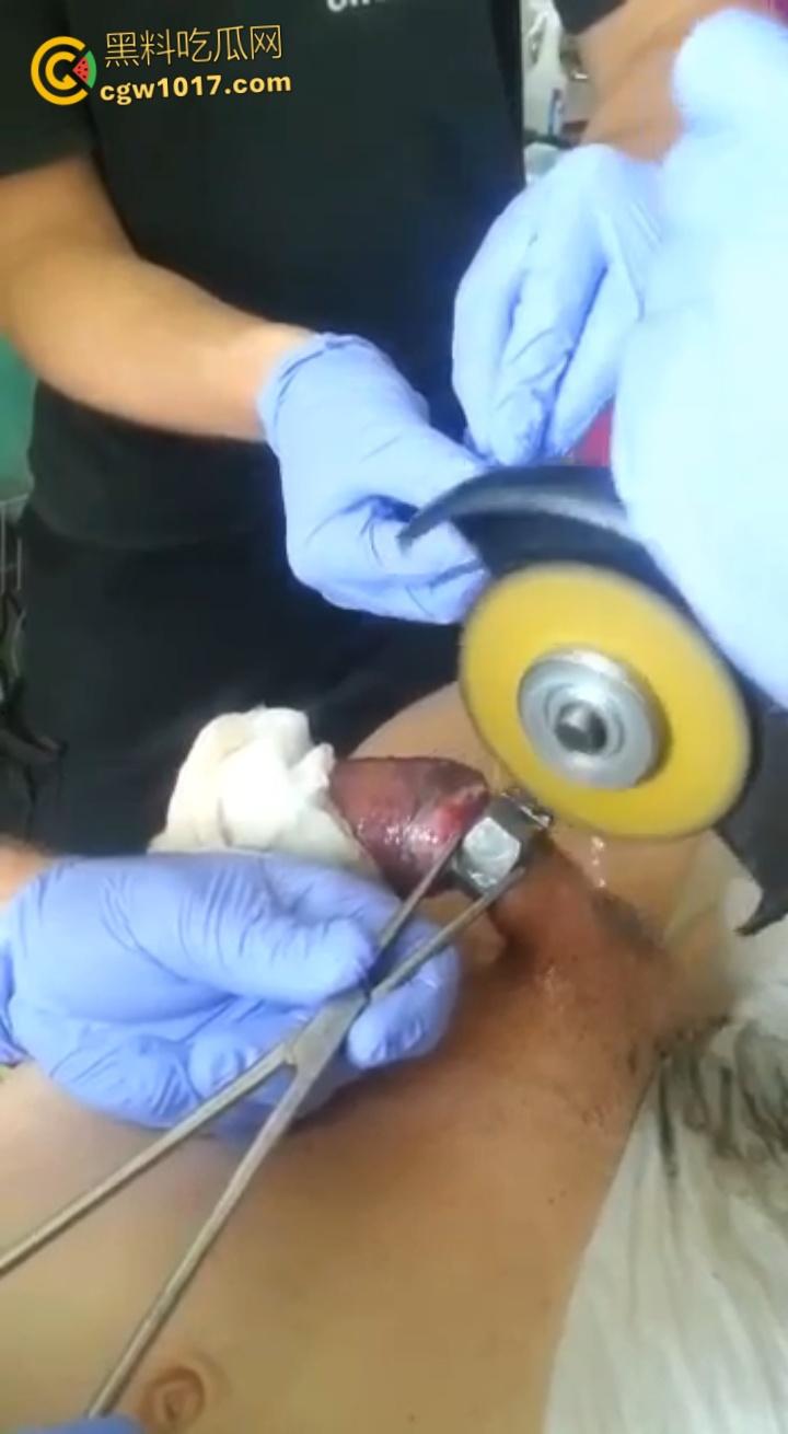 小说照进现实,男子追求刺激螺母自慰,勃起后被螺母卡住,消防人员和医生同时出动,解救被困阴茎 !