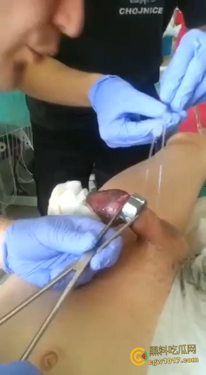 小说照进现实,男子追求刺激螺母自慰,勃起后被螺母卡住,消防人员和医生同时出动,解救被困阴茎 !