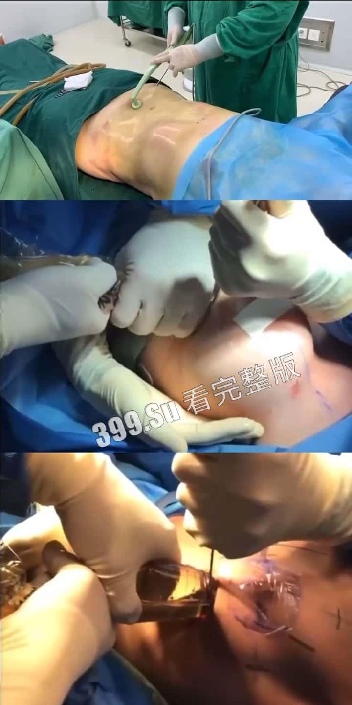 医美整形那些事儿 假的真不了 看的脸皮发麻 (三)