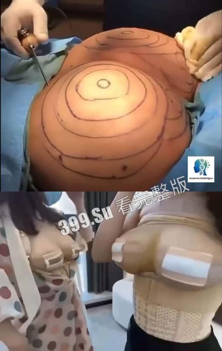 医美整形那些事儿 假的真不了 看的脸皮发麻 (三)