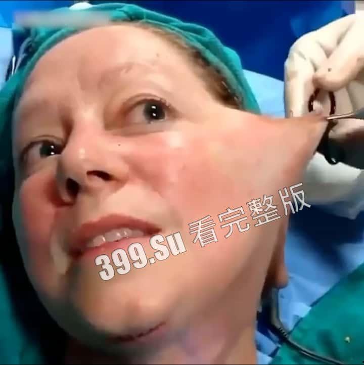 医美整形那些事儿 假的真不了 看的脸皮发麻 (三)