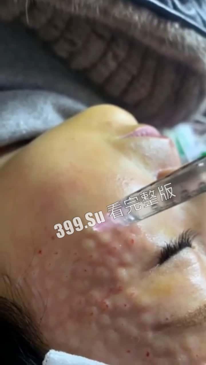 医美整形那些事儿 假的真不了 看的脸皮发麻 (三)