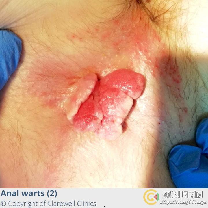 性病篇  谨慎观看！瓜友们出门在外 一定得洁身自爱 世界上没有后悔药  安全第一！！！ （二）