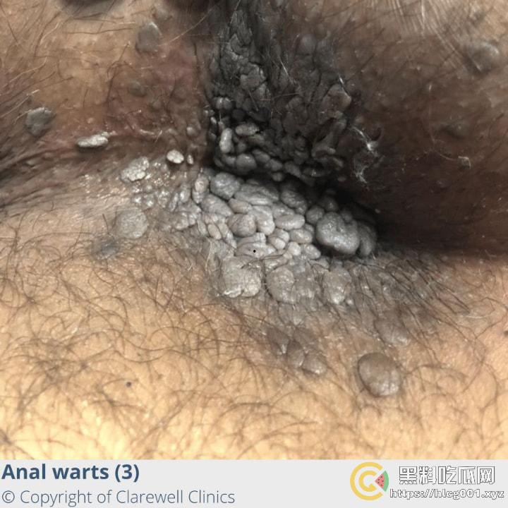 性病篇  谨慎观看！瓜友们出门在外 一定得洁身自爱 世界上没有后悔药  安全第一！！！ （二）