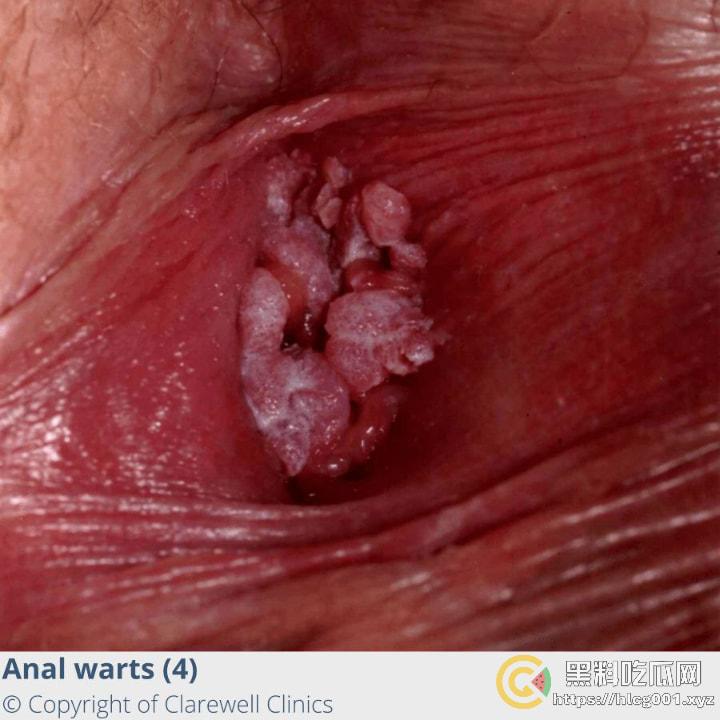 性病篇  谨慎观看！瓜友们出门在外 一定得洁身自爱 世界上没有后悔药  安全第一！！！ （二）