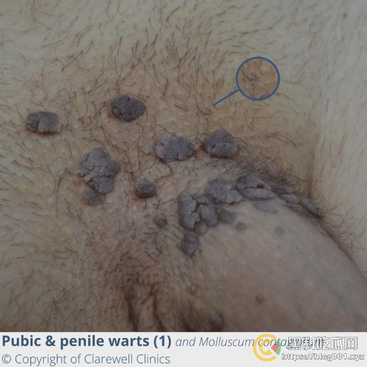 性病篇  谨慎观看！瓜友们出门在外 一定得洁身自爱 世界上没有后悔药  安全第一！！！ （二）