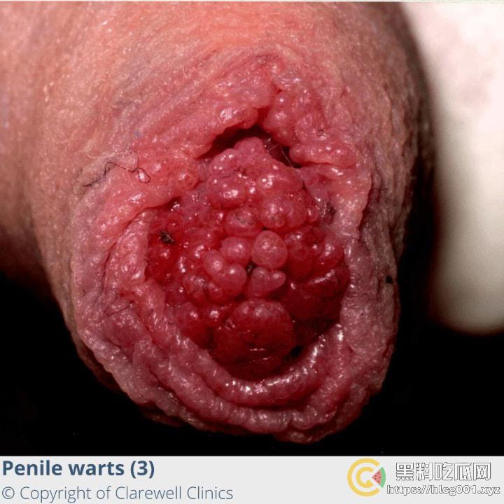 性病篇  谨慎观看！瓜友们出门在外 一定得洁身自爱 世界上没有后悔药  安全第一！！！ （二）