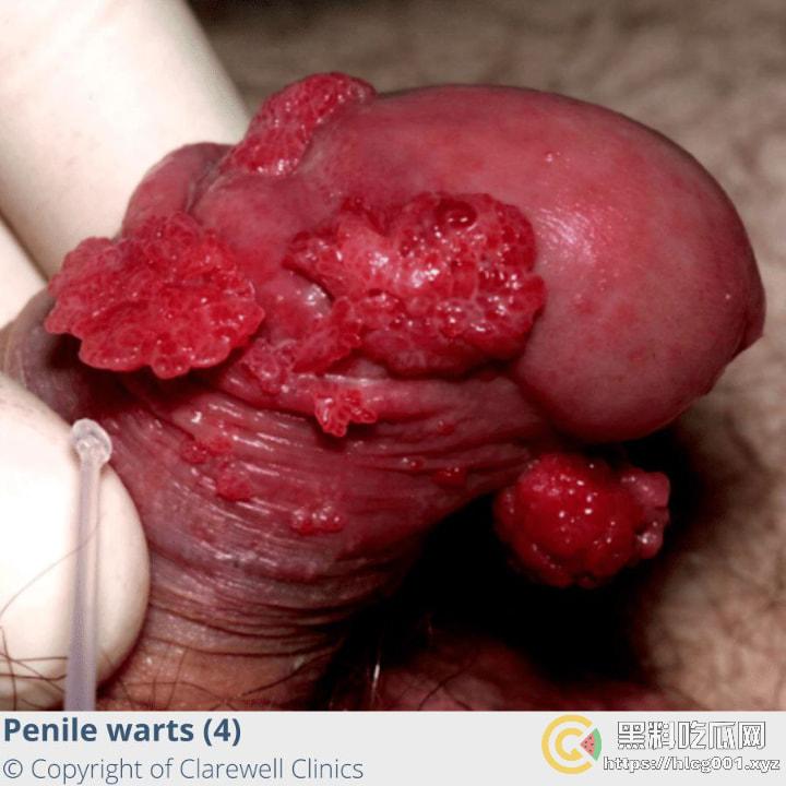 性病篇  谨慎观看！瓜友们出门在外 一定得洁身自爱 世界上没有后悔药  安全第一！！！ （二）