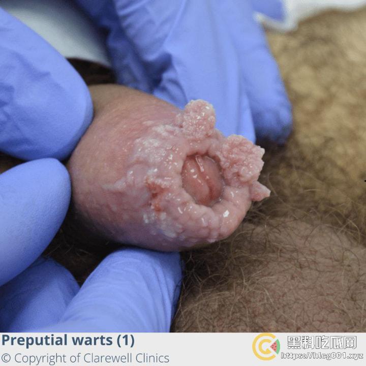 性病篇  谨慎观看！瓜友们出门在外 一定得洁身自爱 世界上没有后悔药  安全第一！！！ （二）