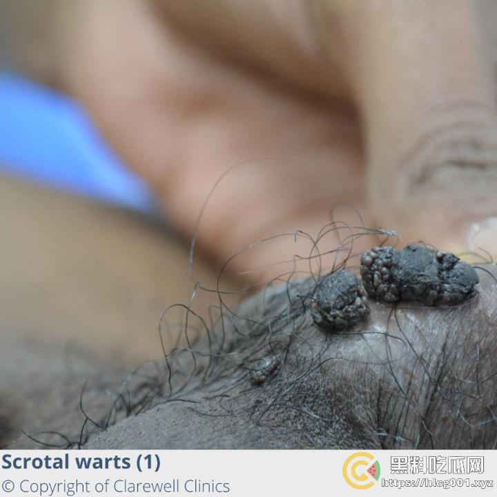 性病篇  谨慎观看！瓜友们出门在外 一定得洁身自爱 世界上没有后悔药  安全第一！！！ （二）