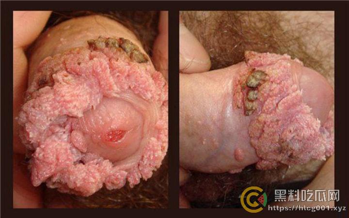 性病篇  谨慎观看！瓜友们出门在外 一定得洁身自爱 世界上没有后悔药  安全第一！！！ （二）