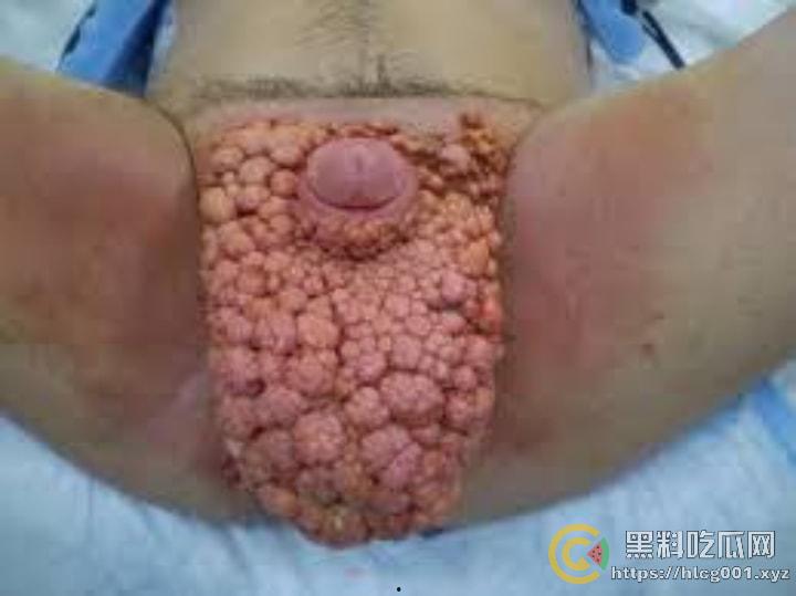 性病篇  谨慎观看！瓜友们出门在外 一定得洁身自爱 世界上没有后悔药  安全第一！！！ （二）